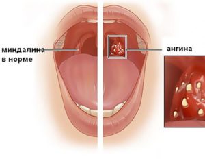 Дырки в миндалинах: причины, лечение и восстановительный период. Дырки в гландах, что это