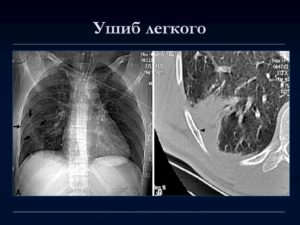 Ранение легкого. Повреждения лёгких