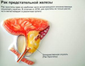 Сколько живут с саркомой простаты. Как лечить саркому простаты. Питание при саркоме