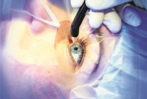 Вопросы лазерной офтальмологии. Виды современных лазерных систем в офтальмологии для коррекции зрения – плюсы и минусы Применение лазеров в офтальмологии