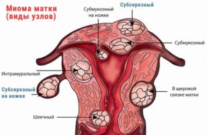 Как удаляется интрамуральный узел матки. Миома матки: что означает диагноз интрамуральный миоматозный узел? Осложнения и лечение