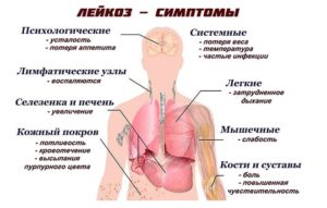 Можно ли вылечить лейкемию или нет. Лейкоз крови у взрослых: первые признаки и симптомы, причины болезни, лечение