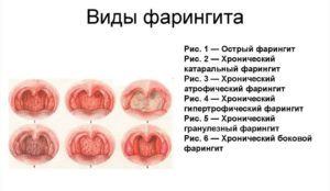 Не проходит фарингит 2 месяца. Долго не проходит фарингит, узнайте, как долго проходит фарингит