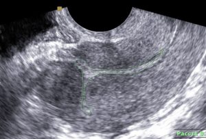 Полость матки после родов норма узи. УЗ-диагностика после кесарева сечения. Как делают послеродовое УЗИ