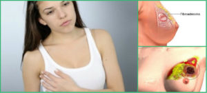 Что делать если появился синяк (гематома) на груди и как лечить уплотнение молочной железы у женщины. Ушиб молочной железы: причины, симптомы, лечение