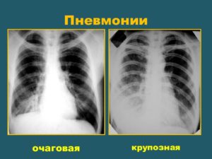 Затемнение в легких без симптомов. Затемнение в легких на флюорографии что это