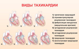 Можно ли умереть от тахикардии. Тахикардия это опасно