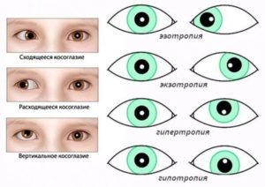 Как избавиться от косоглазия детям и взрослым в домашних условиях? Как исправить косоглазие в домашних условиях