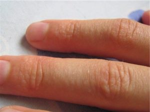 Опухли пальцы на руках и чешутся: причины. Аллергия на руках: виды, симптомы и лечение