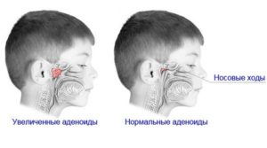 Как можно облегчить дыхание во сне ребенку с аденоидами? Можно ли задохнуться от аденоидов