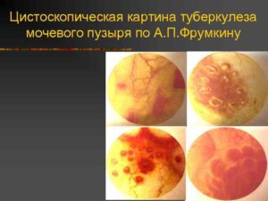 Лечение туберкулез мочевого пузыря у женщин. Туберкулез мочеполовой системы – симптомы и лечение. Причины развития болезни