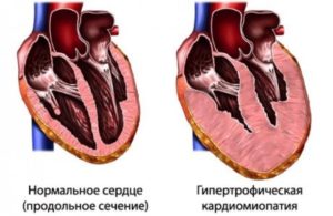 Большое сердце болезнь лечение. Диагноз большое сердце что это такое. Причины роста размеров сердца