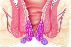После родов трещинка в заднем проходе геморой причины кровит. Как лечить трещины в заднем проходе после родов