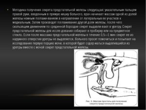 Подготовка к взятию секрета простаты. Анализ сока простаты – показания к проведению. Как проходит процедура взятия секрета простаты