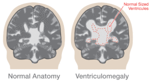 Умеренная дилатация левого бокового желудочка мозга. Расширение желудочков головного мозга у грудничка