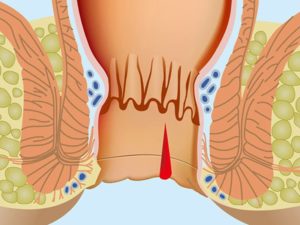 После родов трещинка в заднем проходе геморой причины кровит. Как лечить трещины в заднем проходе после родов