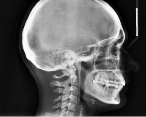 Рентгенография черепа: показания и особенности проведения исследования. Рентген головы: что показывает Обзорная рентгенография черепа