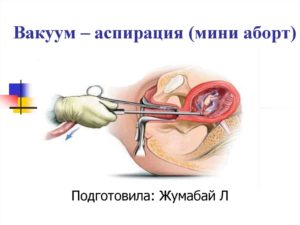 Вакуумная аспирация на каком сроке. Мини-аборт: до какого срока, показания, осложнения. Вакуумное прерывание беременности