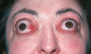 Выпучивать или вытаращивать глаза — это болезнь. Глаза на выкате у человека или экзофтальм — что это за болезнь? Выпирают глаза
