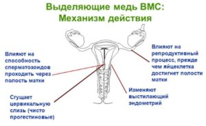 ВМС спираль: побочные действия, отзывы. Женское здоровье