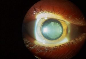 Удаление катаракты при глаукоме. Что такое катаракта и глаукома