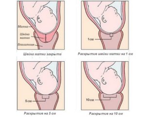 Почему шейка матки становится короткой во время беременности, чем опасно укорочение, как ее удлинить? Удлиненная шейка матки. Медитация для раскрытия шейки матки