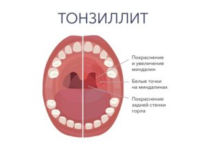 Как лечить волдыри на задней стенке в горле. Волдыри в горле — что это, как лечить, причины