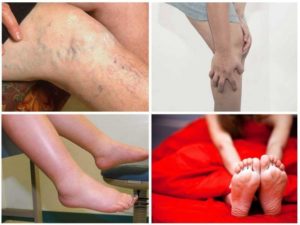 Эффективное лечение варикозных шишек на ногах. Шишки на ногах от варикоза