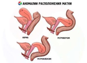 Почему происходит ретродевиация матки и как с ней бороться? Что такое ретродевиация матки, и какая она бывает