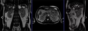 Обследование почек мрт. Что показывает МРТ мочевыводящих путей и почек, как подготовиться к исследованию и чем оно отличается от КТ? Как проводится процедура МРТ