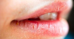 Красная окантовка вокруг губ. Болезни губ – причины, симптомы, лечение. Лечение воспаления уголков губ