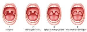 Рыхлые гланды как лечить. Причины и лечение рыхлых миндалин у ребенка и взрослого