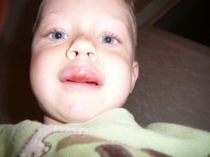 Ребенок разбил губу с внутренней стороны. Что делать, если малыш разбил губу