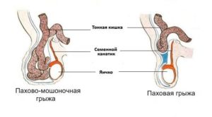 Мошоночная грыжа у мужчин. Что такое пахово-мошоночная грыжа и как ее определить? Методы народной медицины