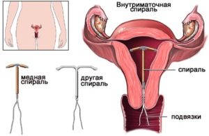 Первые месячные после установки спирали. Спираль мирена и месячные