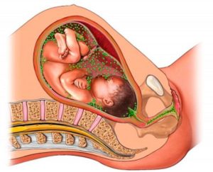 Беременность после лечения хламидиоза. Можно ли забеременеть после хламидиоза