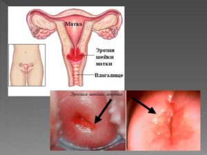 Можно ли прижигать эрозию нерожавшим. Эрозия шейки матки у нерожавших женщин. Особенности лечения