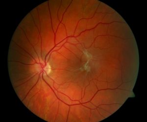 Что такое эпиретинальный фиброз глаз. Народные рецепты для лечение фиброза сетчатки глаза