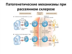 Что нельзя при рассеянном склерозе. Противопоказания при диагнозе РС. Рассеянный склероз (РС)