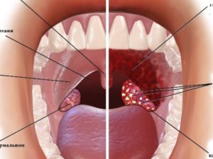 Постоянные гнойники на миндалинах. По каким причинам могут появляться язвы на гландах
