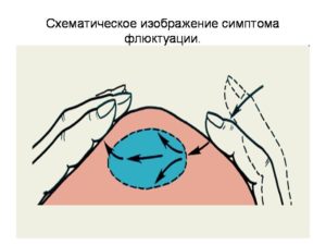 Флуктуация в различных сферах деятельности человека и в медицине. Абсцесс (клиническая картина) Симптом флюктуации