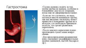 Гастростомия показания. Наложение гастростомы (гастростомия): показания, проведение, жизнь после. Подготовка к гастростомии