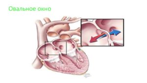 Овальное окно 9 лет может ли закрыться. Если у ребенка обнаружили открытое овальное окно в сердце