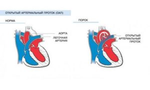 Открытый артериальный проток. Баталов проток. Незаращение Баталова протока. Врожденный порок сердца