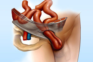 Мошоночная грыжа у мужчин. Что такое пахово-мошоночная грыжа и как ее определить? Методы народной медицины