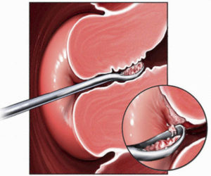 Выскабливание матки после родов. Выскабливание после родов