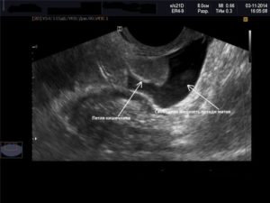 Жидкость в позадиматочном пространстве. Жидкость в позадиматочном пространстве – что это означает