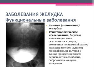 Остановка желудка симптомы и причины. Причины возникновения и признаки непроходимости желудка