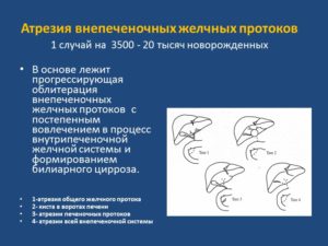 Атрезия желчевыводящих путей у новорожденных. Билиарная атрезия. Показания к трансплантации печени