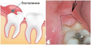 Воспалился зуб температура. Повысилась температура при зубной боли: что делать